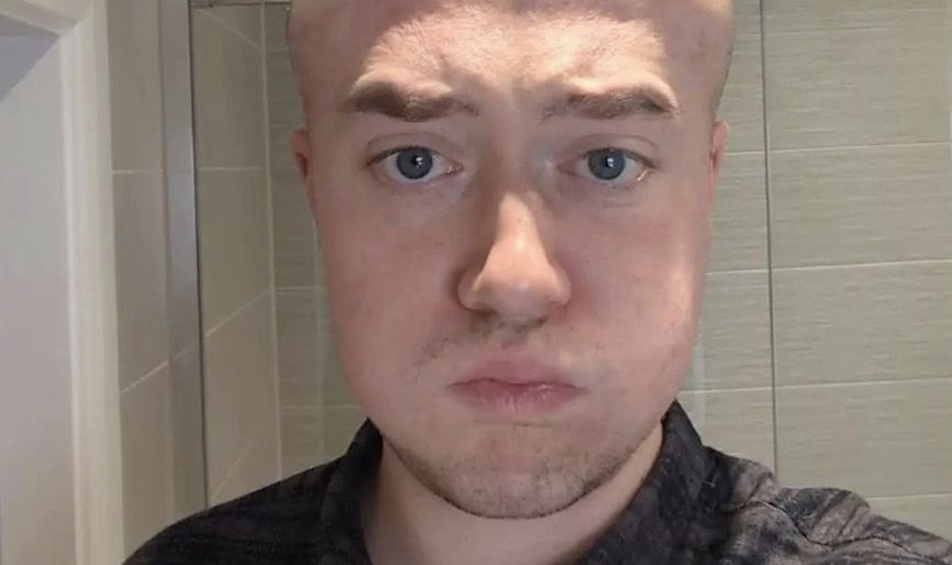 Balding man says he was left 'looking like Megamind' after hair transplant