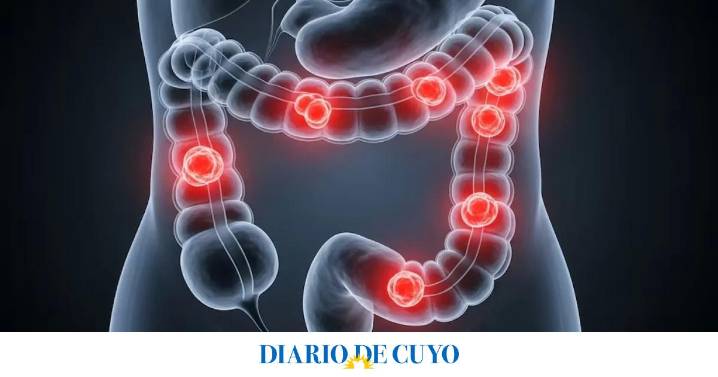 Científicos argentinos desarrollaron un virus que ataca el cáncer colorrectal y sus células resistentes