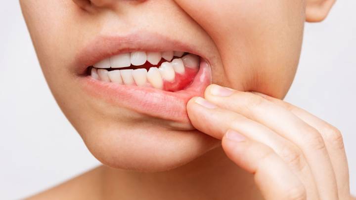 Dentists reveal the worst foods for gum inflammation