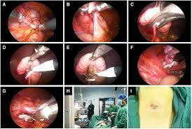 Factors that may Influence HRQoL and recovery after Appendectomy, reveals research