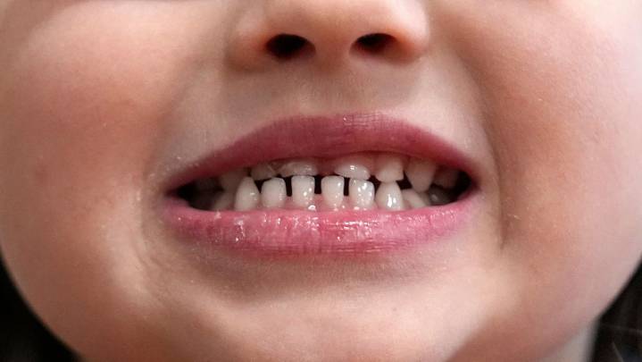 FDA restricts use of kids' fluoride supplements citing emerging health risks