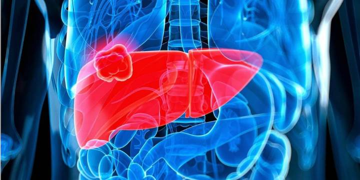 Estos son los 5 principales síntomas del cáncer de hígado