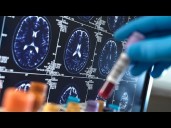 Alzheimer's may be preventable if treated before symptoms appear, study suggests