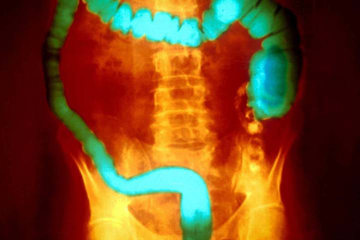 Common type of inflammatory bowel disease linked to toxic bacteria