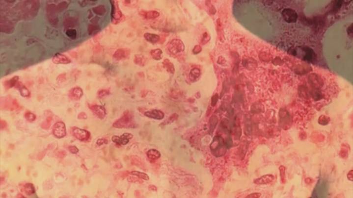 LDH reports third measles case of 2025; exposure possible at Louis Armstrong New Orleans International Airport
