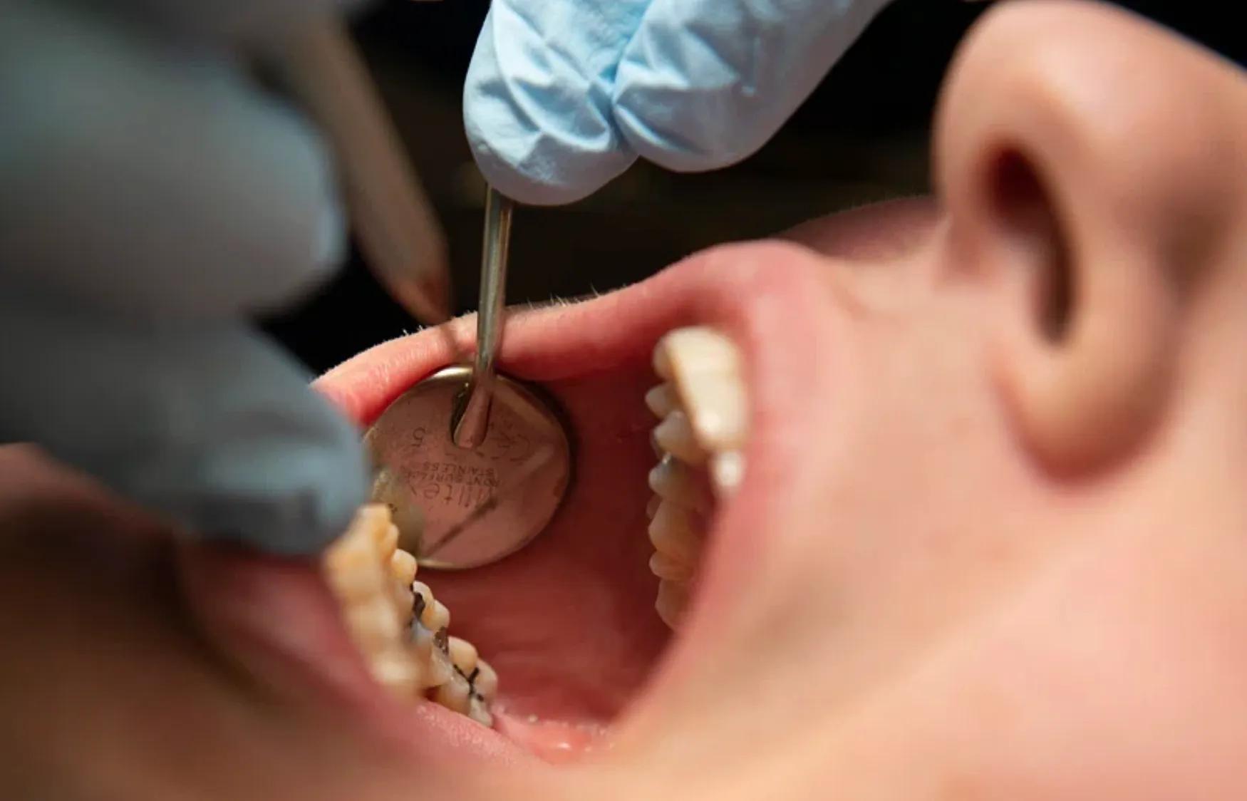 FDA restricts use of kids’ fluoride supplements citing emerging health risks