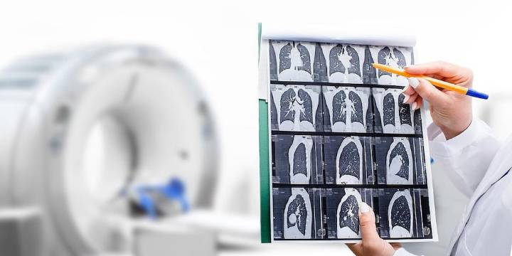 Se podrían prevenir tres veces más muertes por cáncer de pulmón con un solo paso