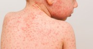 Aumentan los casos de sarampión en el mundo: OMS alerta riesgo de nuevos brotes por baja vacunación