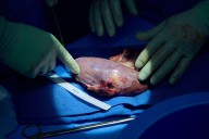 Doctors say they’re ‘measurably closer’ to making pig kidneys work for humans
