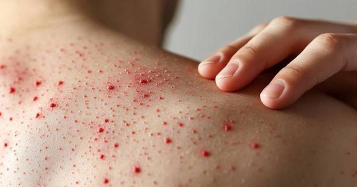 Alertan por viajeros con sarampión que circularon por varias provincias