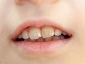 ¿Por qué salen manchas blancas en los dientes?