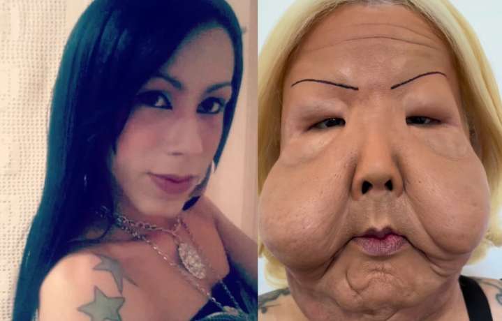 Influencer queda irreconocible tras recibir inyecciones de aceite y laxante en clínica ilegal