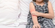 COVID Vaccine Offers Health Boost For Kids With Eczema