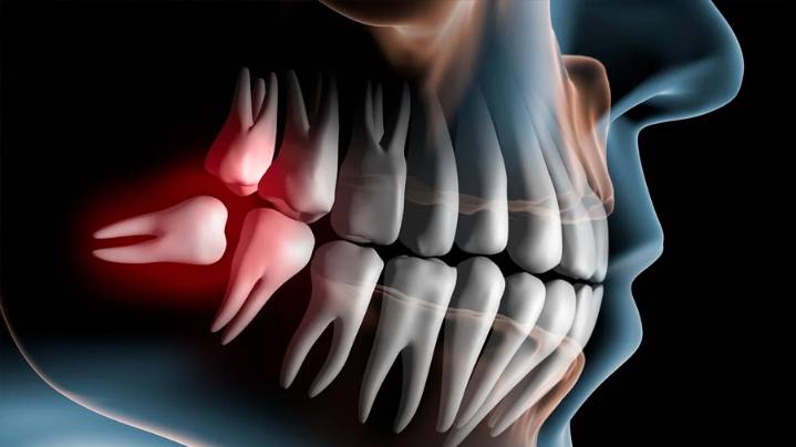 ¿Desaparecerán las muelas del juicio?