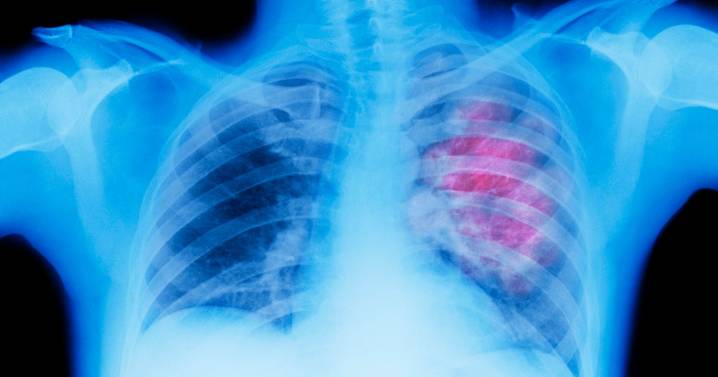 New report shows improvements in lung cancer treatment in Pennsylvania