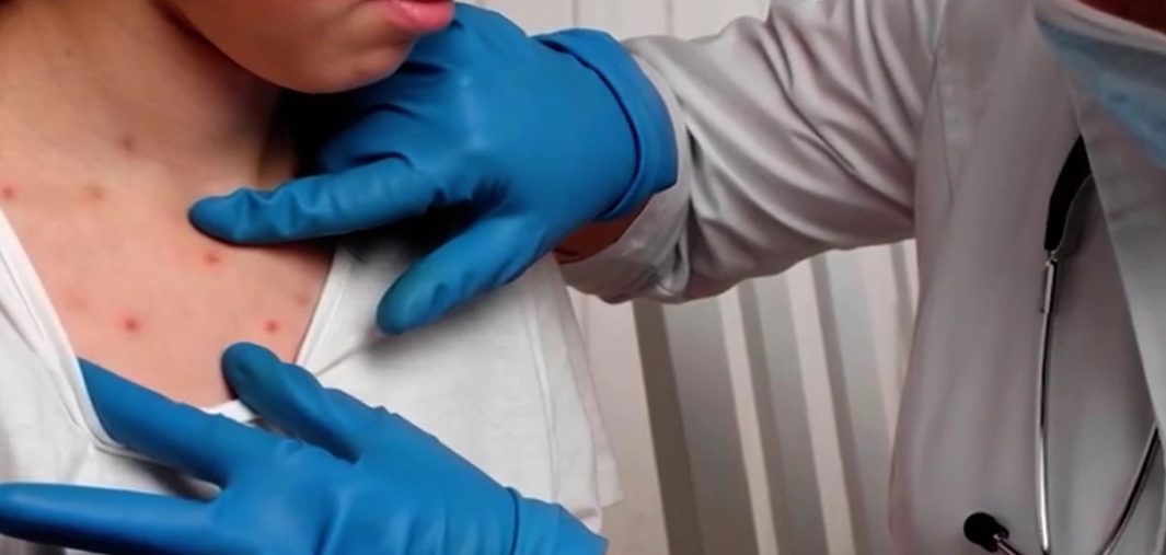 “Vamos a empezar a ver estas cosas”: alerta en la región por un caso vinculado a un brote de sarampión