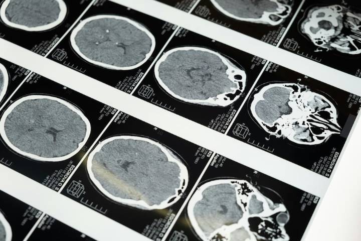 Esta es la clave para reconocer a un psicópata: científicos descubren que su cerebro es distinto al de una persona común