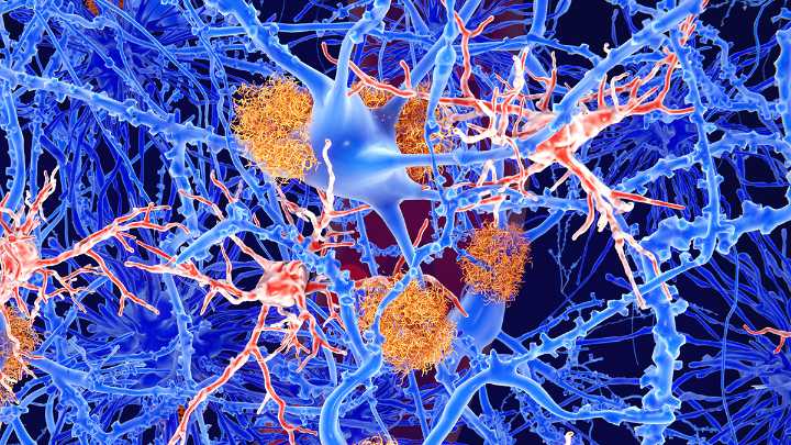 One of Our Biggest Hopes For Alzheimer's Treatment Doesn't Seem to Work