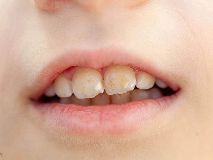 ¿Por qué salen manchas blancas en los dientes?