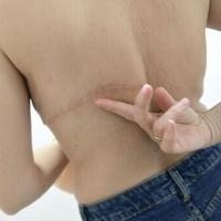 'Forgotten' women demand justice in Spain breast cancer scandal