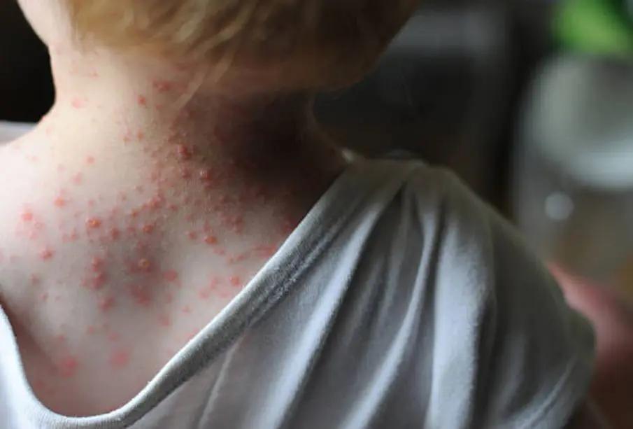 OPS alerta por brote de sarampión en México: el país concentra la mayoría de muertes en América