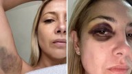 Fabiola Yáñez reveló si fue mentira lo de sus fotos con el ojo morado y moretones