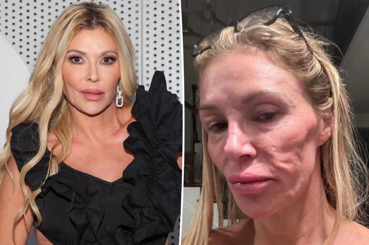 Brandi Glanville shares new health update after grueling battle with her facial disfigurement