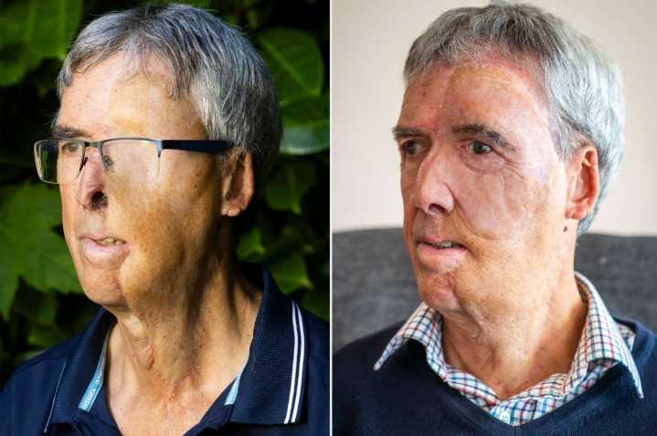 El impactante caso de Dave: Tiene una nueva «cara» gracias a la impresión 3D