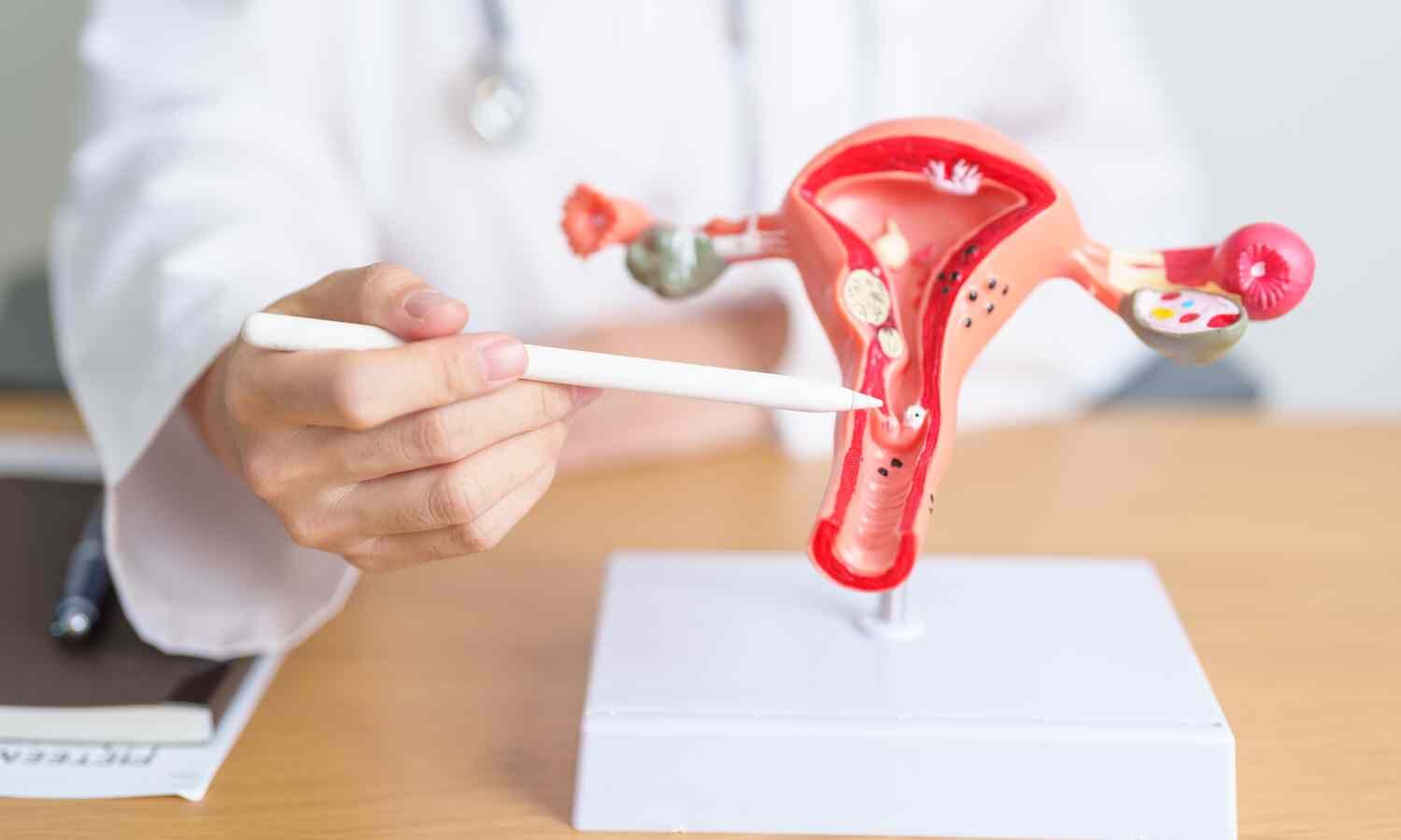 Patients with early Endometrial Cancer who don't undergo Hysterectomy have Higher Mortality: Study
