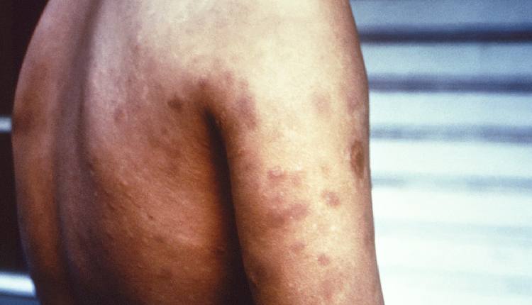 Leprosy Now A ‘Notifiable Disease’ In Maharashtra