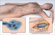 Sentinel Lymph Node Biopsy Alone Matches full Lymphadenectomy for disease free survival in Early...