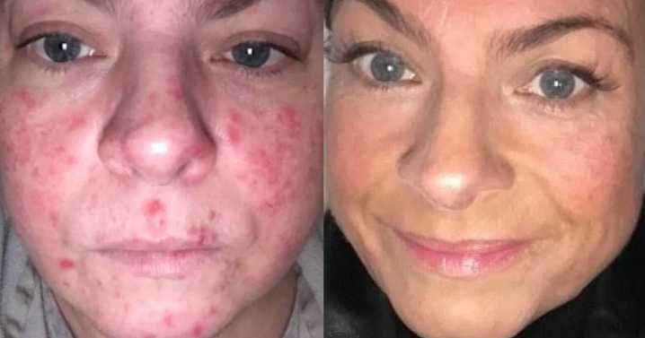 Best Black Friday beauty deal as 'life-changing' bad skin serum cut to £24