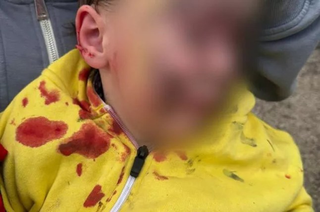 Boy, 5, hospitalised after being mauled by ‘bull breed’ dog