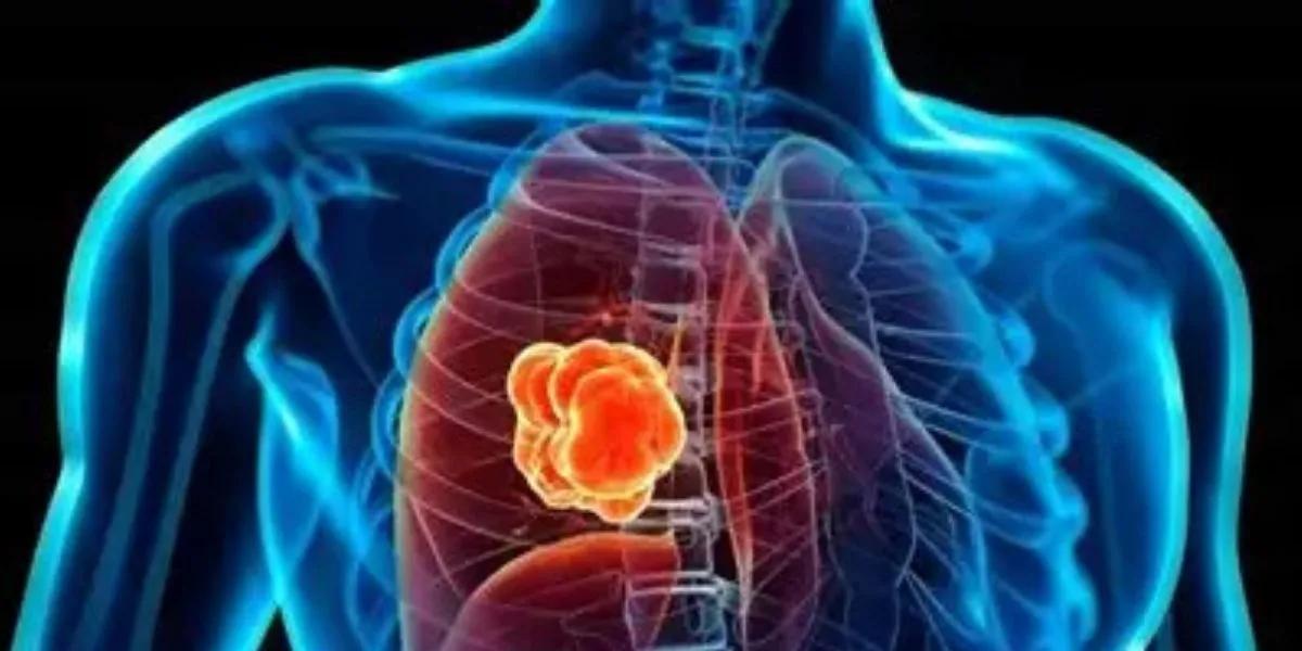 Descubra la proteína que impulsa el crecimiento del cáncer de pulmón