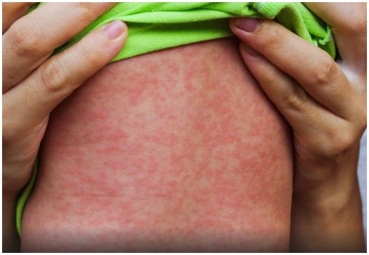 El país de América que perdió el estatus de libre de sarampión y cómo afecta a la Argentina y al resto de la región