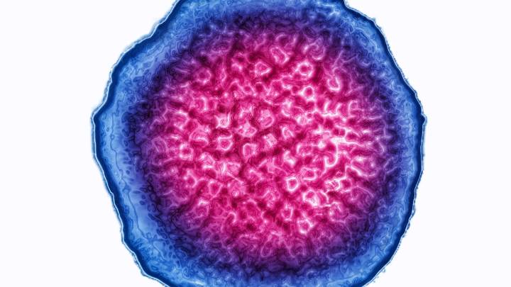 This virus infects almost everyone—and it may lead to lupus