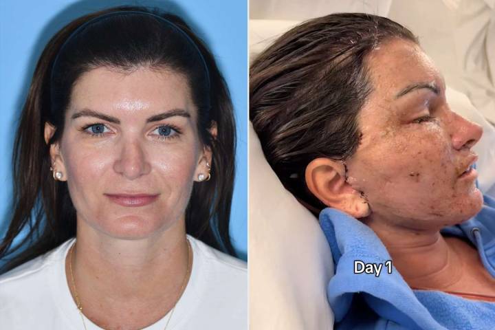 Woman Spends $78K on Face Lift, Then Questions ‘What the F--