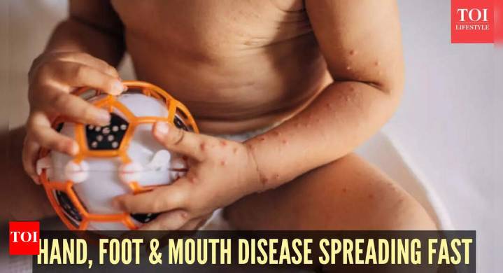 Hand, foot and mouth disease rise in the US: Doctors warn about symptoms, share prevention tips
