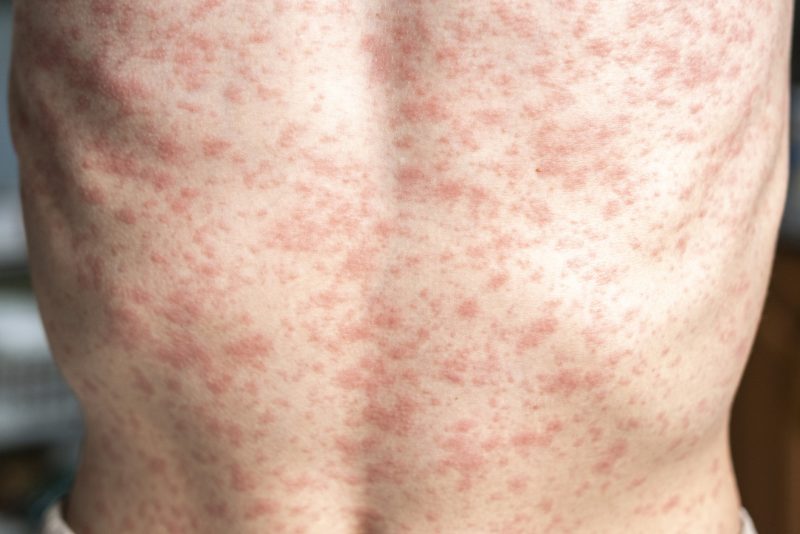 Louisiana Department of Health confirms measles case linked to travel