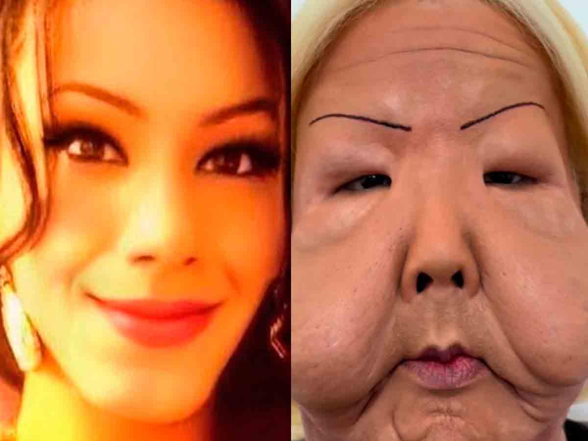 Influencer inicia reconstrucción facial tras quedar desfigurada en procedimiento clandestino