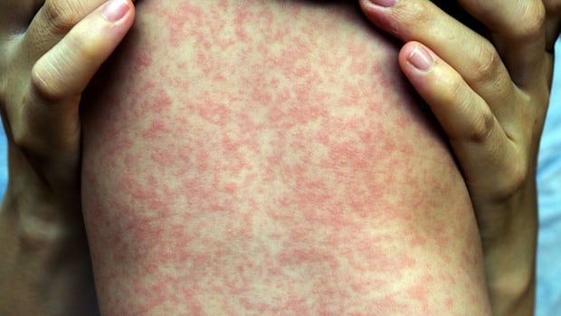 4 more measles cases confirmed in Manitoba