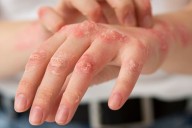 “Nos inquieta la situación”. La región dejó de ser libre de sarampión y se activan alertas sanitarias