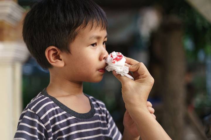 Radiofrequency Coagulation Effective for Recurrent Anterior Epistaxis