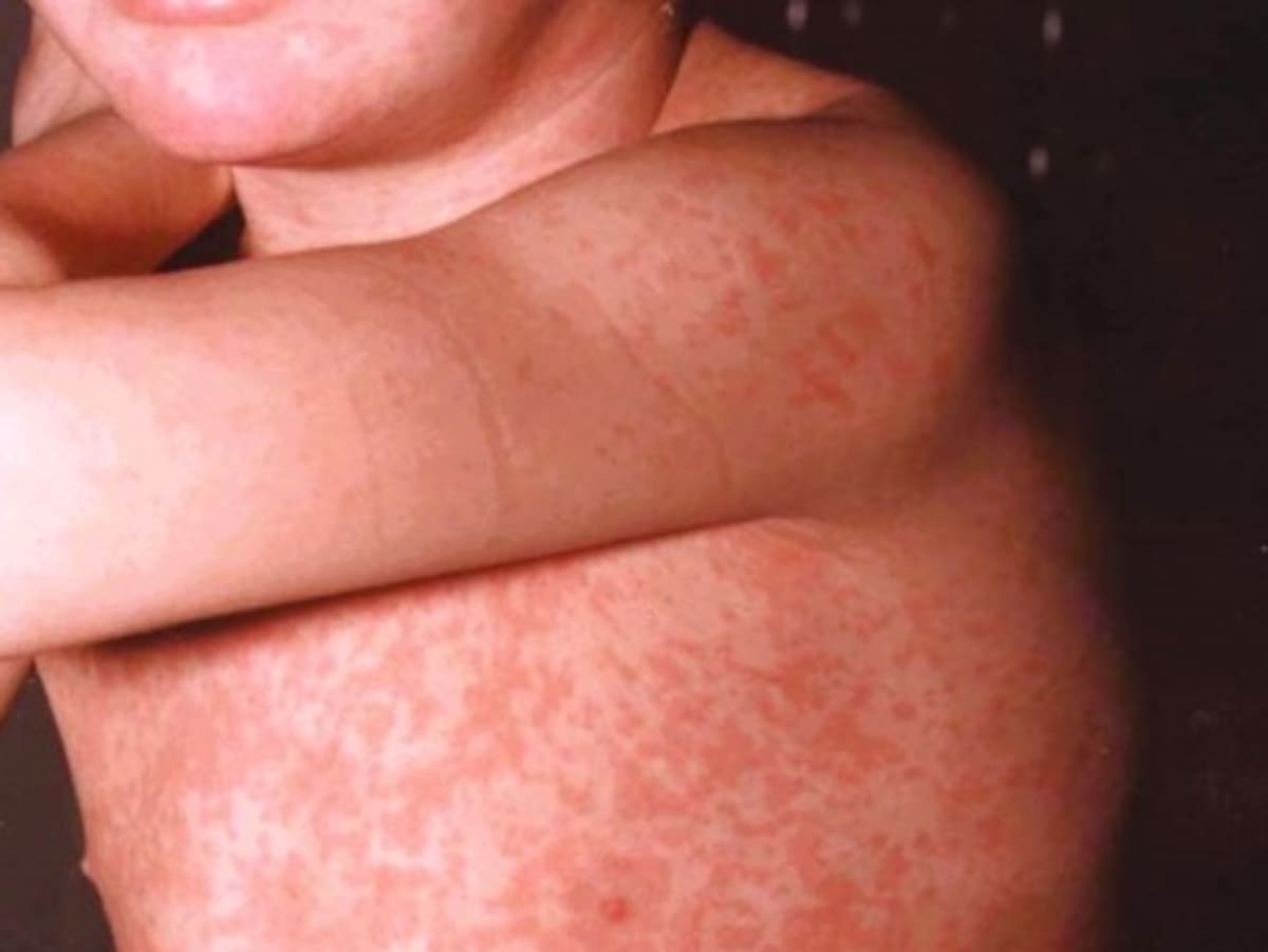 "Una gran alarma". La OMS alerta sobre el incremento de los brotes de una enfermedad viral en la Argentina y la región