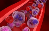 Treatment of Multiple Myeloma at Specialized Clinic Tied to Improved Survival