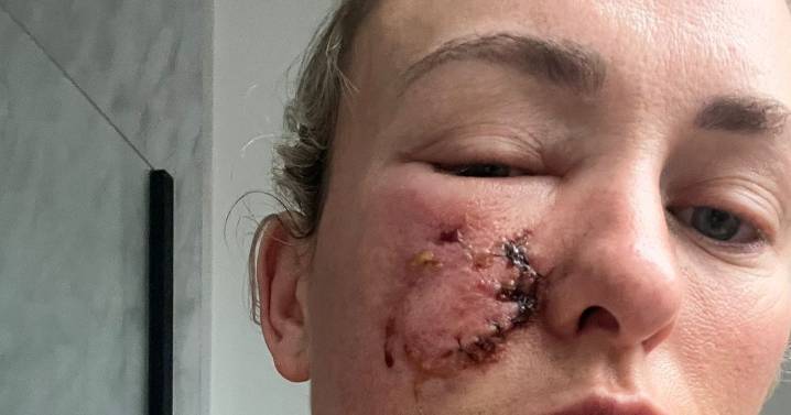 Woman bit by her own dog can 'look in mirror again' after laser treatment