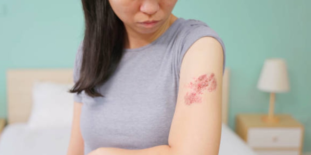 ¿Qué es el herpes zóster? Esto es lo básico que debes saber sobre la enfermedad