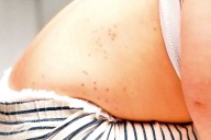 Primer caso de sarampión en la entidad