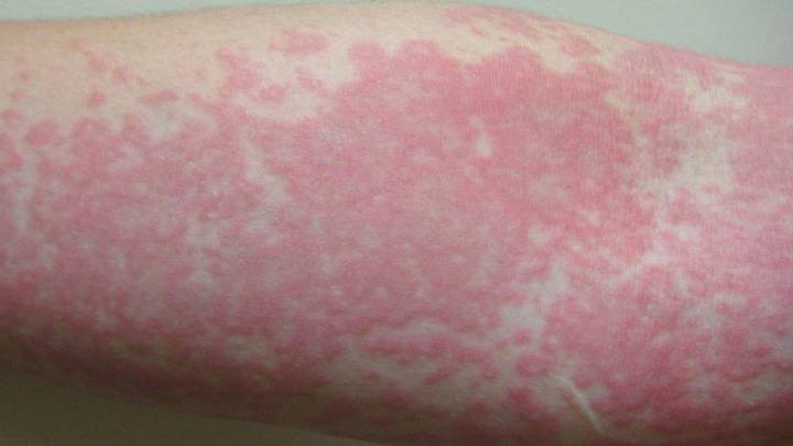 ¿Con el frío aumentan las urticarias? Cuáles son los síntomas, tipos y cómo prevenir el picor