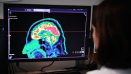 El mapa del desarrollo cerebral que abre la puerta a tratar trastornos incurables